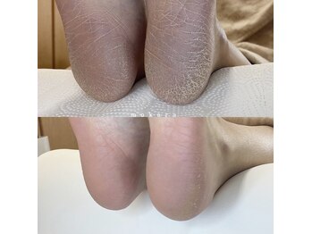 ◇フット角質ケア◇