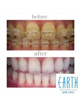アース 福岡天神店(EARTH)/before　after　【美白】