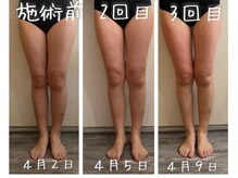 リエラ(Liella)/選べる1箇所痩身コース
