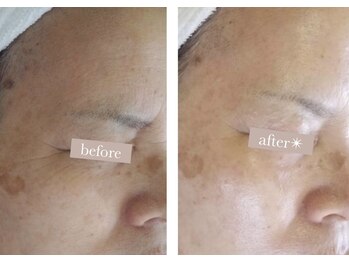 エバーグリーン(Evergreen)/ハーブピーリング6回の変化