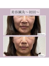 リマナ(Limana)/美容鍼灸1回目ビフォーアフター