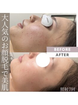 モアトゥインクル 福山宮通り店(MORE twinkle)の写真/\脱毛×ぷるん肌♪/ちゅるちゅるコラーゲン脱毛【人気NO.1★お顔2回¥5500】フォト効果付きでエステ級美肌