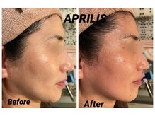 アプリリス(APRILIS)/たるんだフェイスラインの救世主