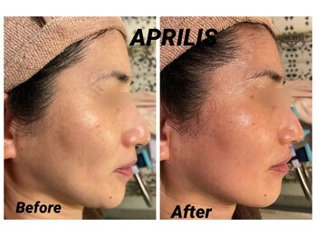アプリリス(APRILIS)/たるんだフェイスラインの救世主