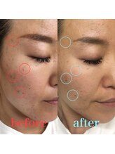 皇漢堂鍼灸療院/肌質改善美容鍼 初回¥5000