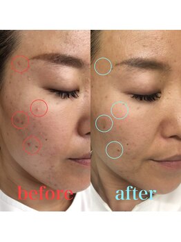 皇漢堂鍼灸療院/肌質改善美容鍼 初回¥5000