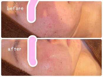 ヒメミ(Himemi)/BBL光エステ