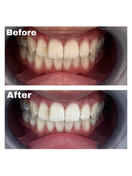 ファストホワイトニング くずは店(FAST WHITENING)/