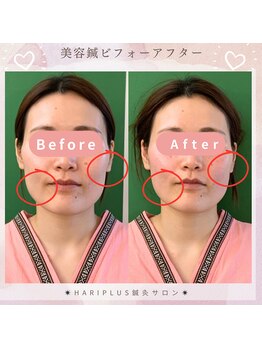 ハリプラス(HariPlus)/美容鍼ビフォーアフター
