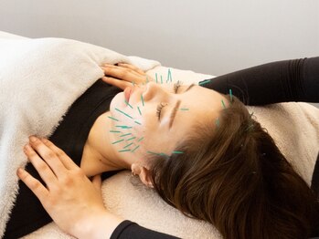 ソセイラボ ウェルネス(SOSEI Lab. wellness)の写真/【女性鍼灸師による本格美容鍼！】小顔効果が期待できるだけでなく、リフトUPやたるみケアにも最適◎