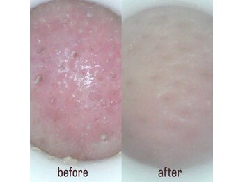 エム シャルール(M chaleur)の写真/【毛穴レス水光肌フェイシャル】ごっそり取れた汚れに感動!見える毛穴洗浄×美容液導入