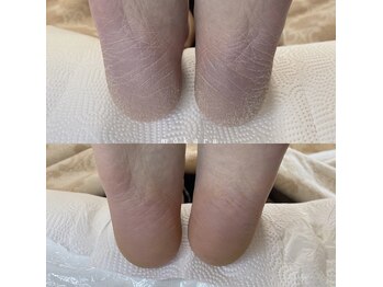 ◇フット角質ケア◇