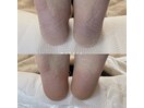 ◇フット角質ケア◇
