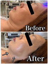 ブランシュール/小顔タイト×エンビロン