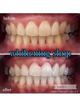 ホワイトニングショップ 桜木町店/【歯の色20トーンUP】