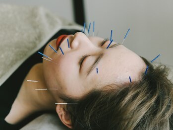 アキュネ 福岡薬院店(acune)/福岡/薬院/美容鍼/美肌