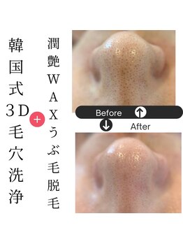 エミア(Emia)/韓国式3D毛穴洗浄＋wax脱毛(鼻)