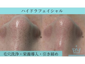 リメイククリニカルビューティー(Remake clinical beauty)/ハイドラフェイシャル