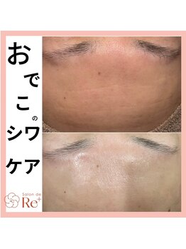 サロン ド リー 輪之内店(Salon de Re+)/おでこのシワが気になる方へ