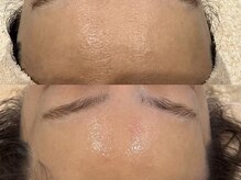 キュアフロウ 橿原店/4回来店☆肌のキメ作り