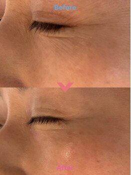 リュウ鍼灸院 サロン ド リュウ(Salon de Ryu)/高濃度水素パック