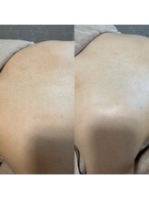 リア(Li'a.)/潤艶WAX脱毛★背中