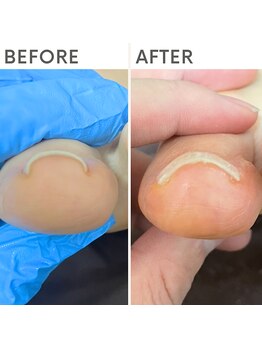 クオッカ(Quokka)/巻き爪ケア