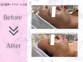 リライフ(ReLIFE)/韓国肌管理/毛穴洗浄+ララピール