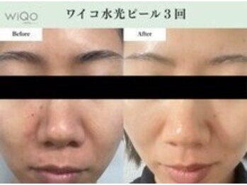 プティ カシェット 伊丹店(petit cachette)/ワイコWiQoビフォー・アフター4