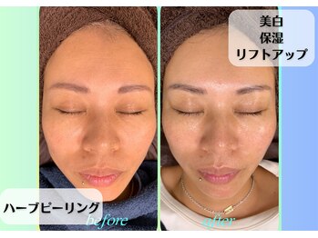 ラヴェンナサロン トウキョウ(Ravenna Salon Tokyo)/ハーブピーリングでリフトアップ