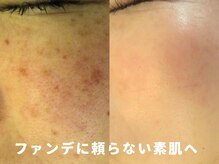 サロンドエステケイワイ(de KY)の雰囲気（ファンデに頼らない素肌へ|濃いシミ改善で印象が変わる！）