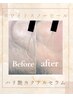 【シワ・たるみ】白雪ピール+濃厚C導入★『通常¥16500→¥8800』