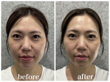 ルー ハナレ 神戸岡本 摂津本山店(Luu HANARE)/Luuスタッフ１回目リフトアップ