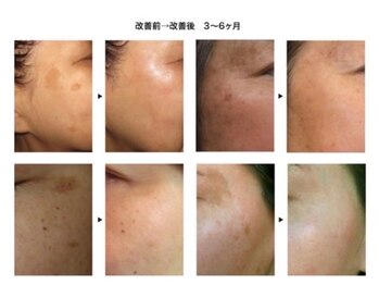 サロンドボーテ ノンノン(Salon de Beaute Non-non)/シミ・シワ改善 美肌コース