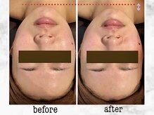 ナチュラーレ 京都四条烏丸店(Naturale)/美肌ニキビケア小顔フェイシャル