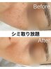 【期間限定】シ ミ 取放題＋クールパック（ホームケアビタミンクリーム付）