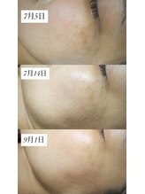 ミュベル(Myubelle)/モヤッとしみ改善