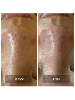 フェイシャルサロン ミギー(Miggie)/ボコボコ毛穴にさよならしたい。