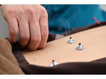 エド鍼灸院 日本橋(EDO鍼灸院)/台座灸