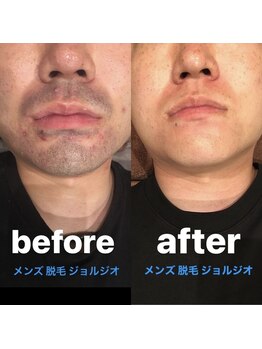 メンズ脱毛 ジョルジオ(GIORGIO)/青ヒゲもスッキリ