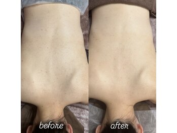 スピカ(Spica)/ブライダル前の背中ケア