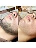 【メンズ】髭ワックス脱毛☆眠れるWax脱毛を体験ください♪