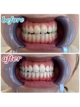 エクシアホワイトニング 前橋店/ビフォーアフター