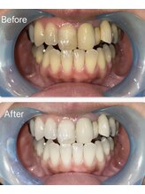 ホワイトニング専門店　スマイルホワイト/40代女性