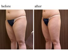 ウィズマツオカ 光の森店/エルフィーノ痩身(12回)効果写真