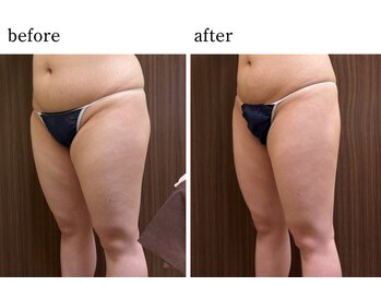 ウィズマツオカ 光の森店/エルフィーノ痩身(12回)効果写真