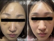 術後インディバ専門サロン 新宿の雰囲気(《リフト/ビフォーアフター》術後インディバ/硬さ内出血緩和)