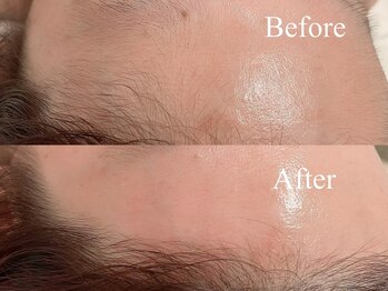 パルフェ 問屋町店(Parfait)/【フェイスWAX脱毛】