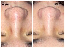 エルマナ(Hermana)/毛穴ケアビフォーアフター