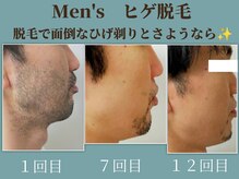 ラーナ(Lana)/ヒゲ脱毛　before→after